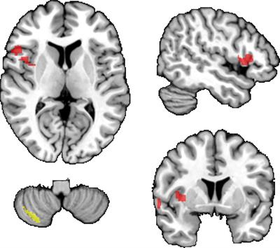 Higher Body-Mass Index and Lower Gray Matter Volumes in First Episode of Psychosis